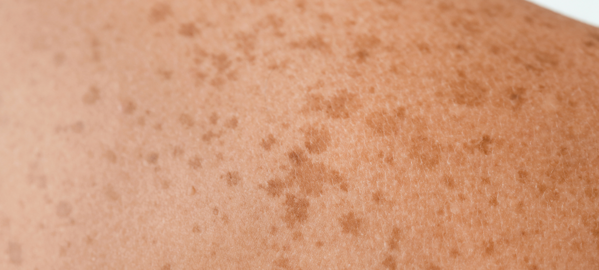 Why does the sun damage my skin?