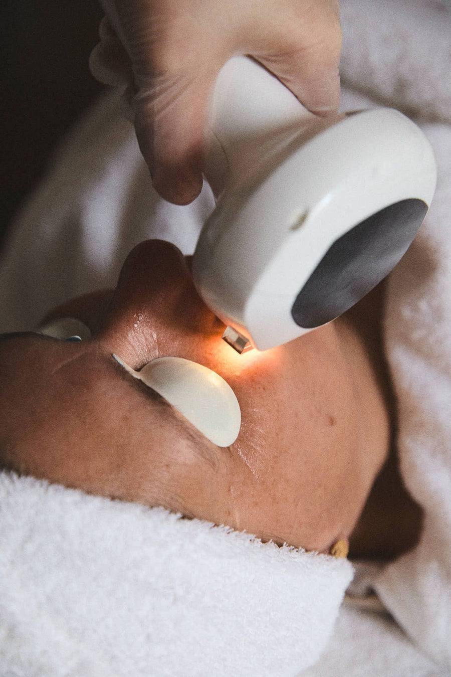 Lumecca IPL