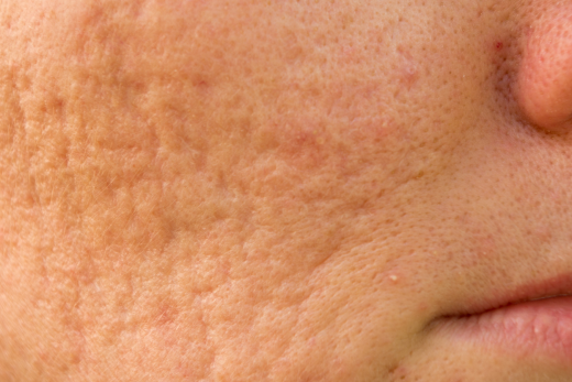 Acne Scarring Treatments Dr David Jack London