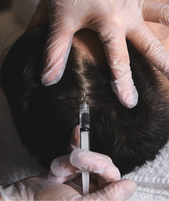 Platelet-Rich-Plasma (PRP) for Hair Loss