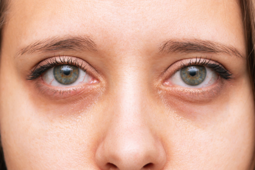 How to Treat Ageing Under the Eyes:  A Complete Guide from Skincare to Surgery for Dark Circles