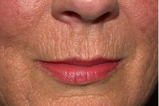 smokers lines treatments dr david jack