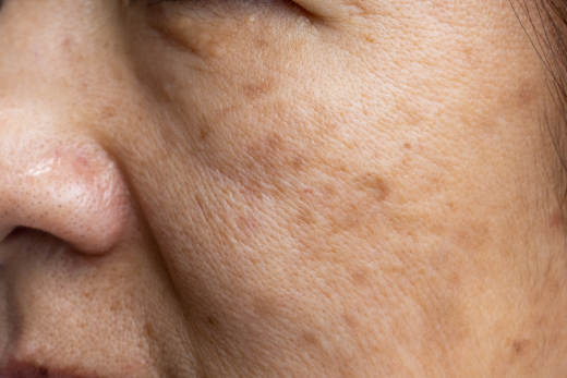 The Best Skincare Ingredients for Pigmentation Issues