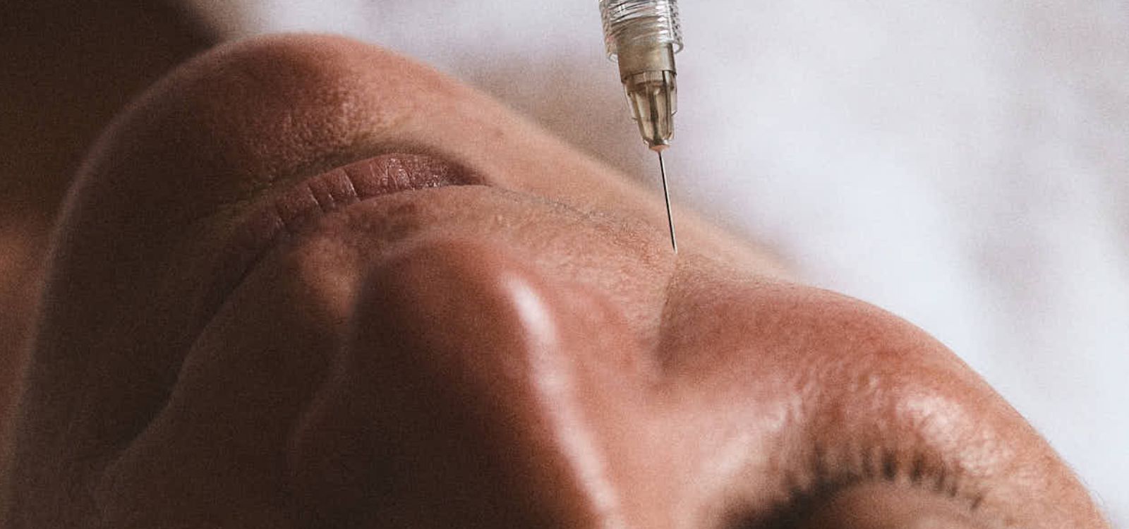 Deep Plane Fillers: The Anatomical Approach to Natural Facial Rejuvenation