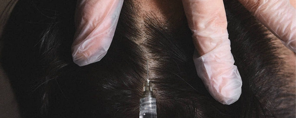 Platelet-Rich-Plasma (PRP) for Hair Loss