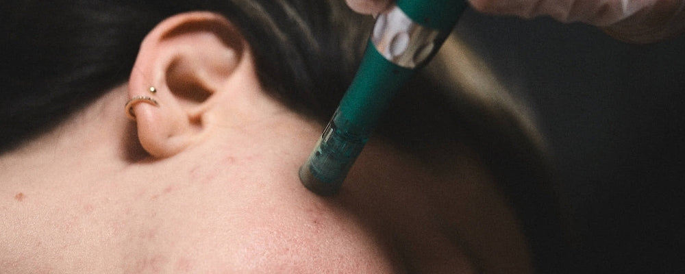 Pigmentation Facial