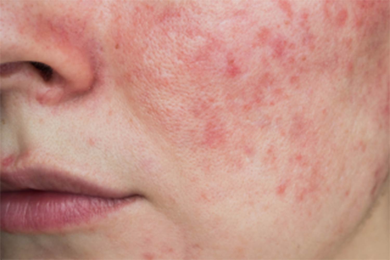Choosing An Effective SPF For Rosacea or Acne