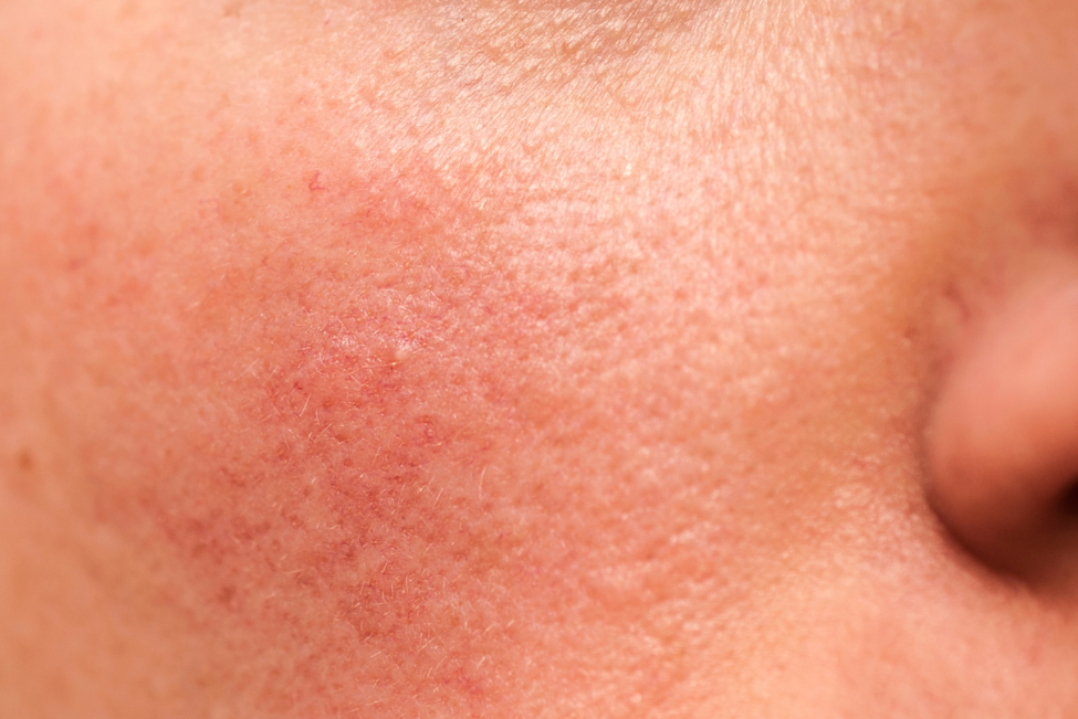 How to look after your skin in Winter: A Doctor’s guide to navigating the Cold Weather
