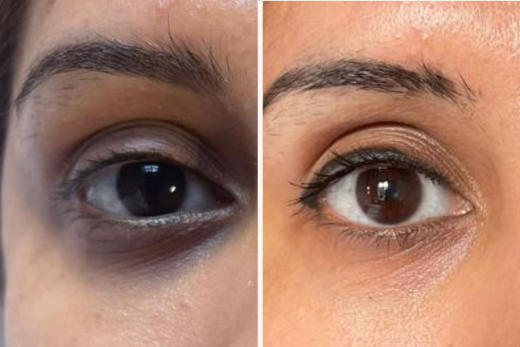 What are dark circles and how do you treat them?