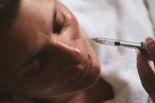 Treating Nasolabial Folds with Fillers: My Approach to Restoring Midface Architecture