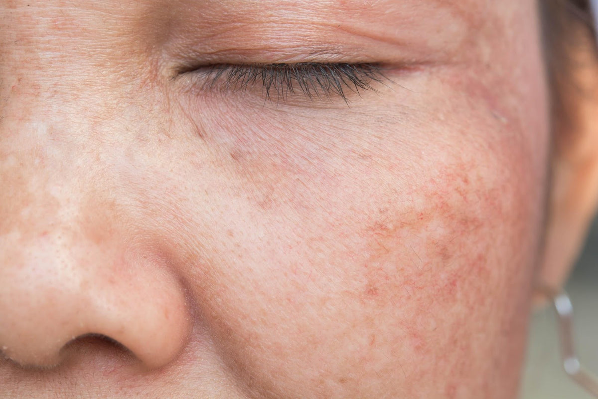 close up on ladies face showing Hyperpigmentation