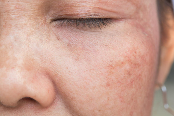 Hyperpigmentation -What Is It And Are There Any Treatments?