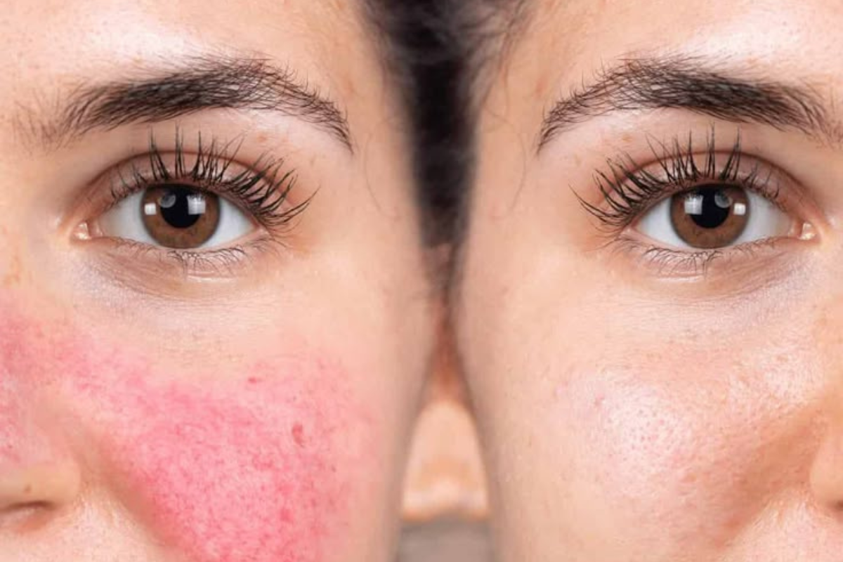 skincare for rosacea