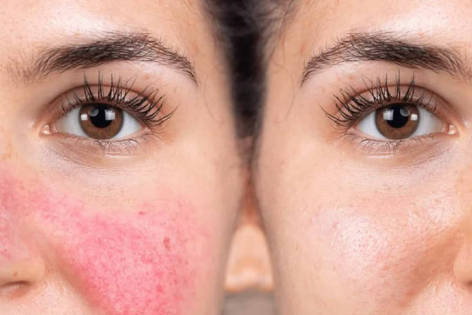 Rosacea: What is it and how can it be treated?