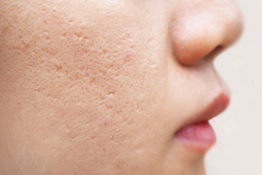 acne scarring