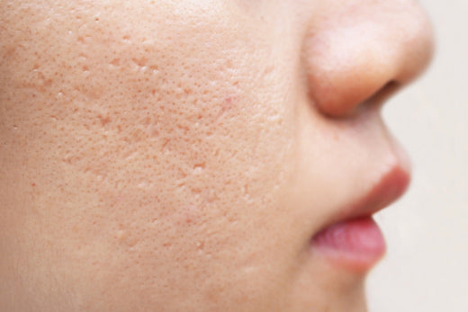 How to treat acne scars - An overview of treatment options
