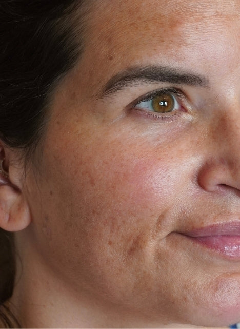 After Pigmentation Facial