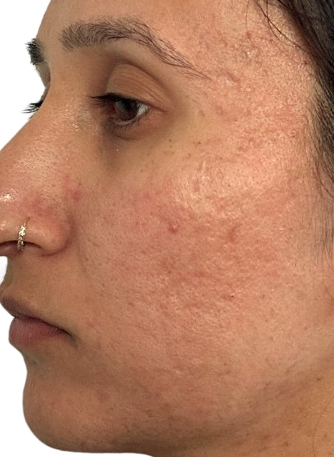 After UltraClear Scarring