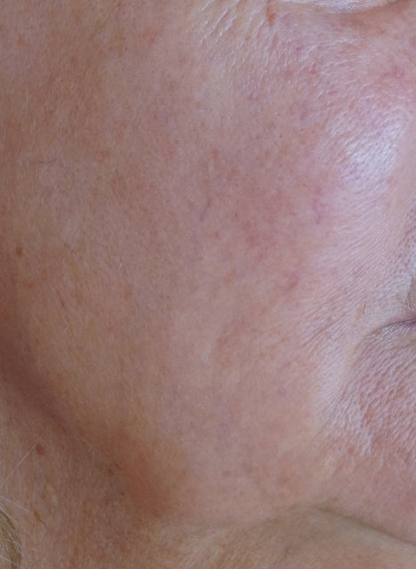 After Lumecca IPL