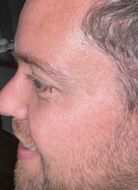 After Anti-Wrinkle Injections