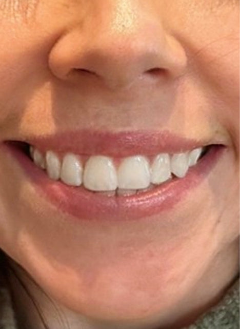 After Neurotoxin Injections