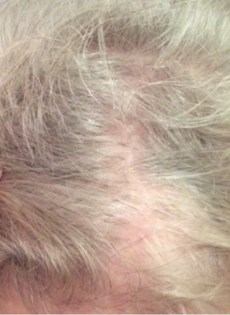After PRP For Hair Loss