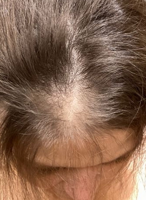 After PRP For Hair Loss 