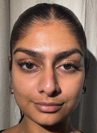 Yellow Face Peel after 1