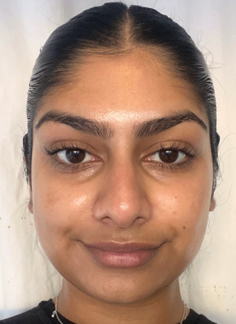 Yellow Face Peel before 1