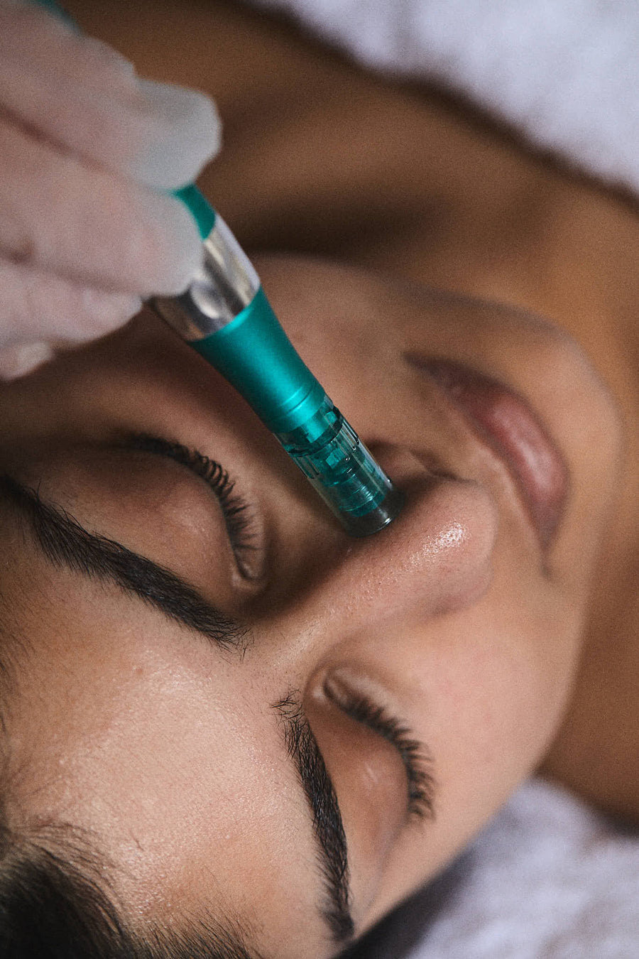 Microneedling