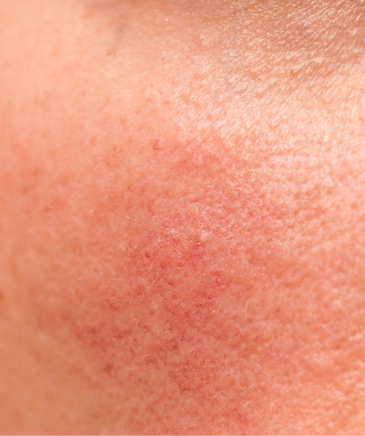 treatments for rosacea