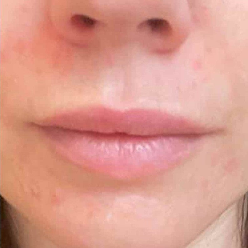 The same lower face after the Daily Skin Trio regime, with calmer, more even skin