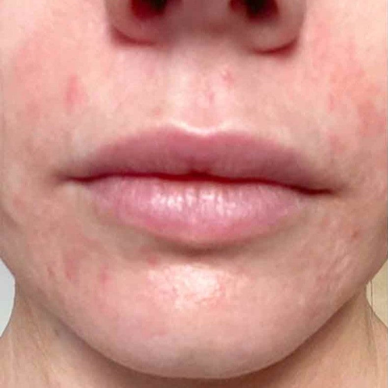 Lower face before the Daily Skin Trio regime, showing redness and uneven texture
