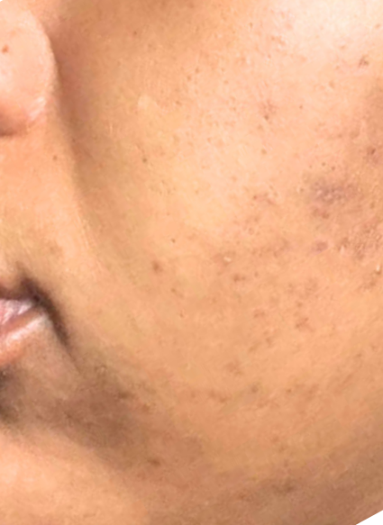 acne facial 1 after