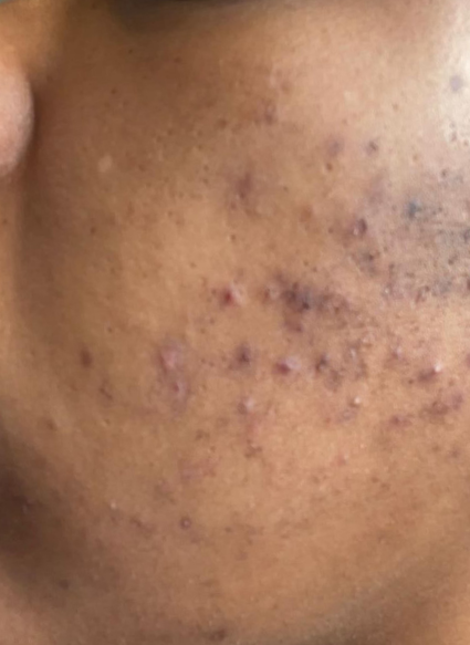 acne facial 1 before