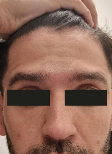 anti wrinkle injections 1 after