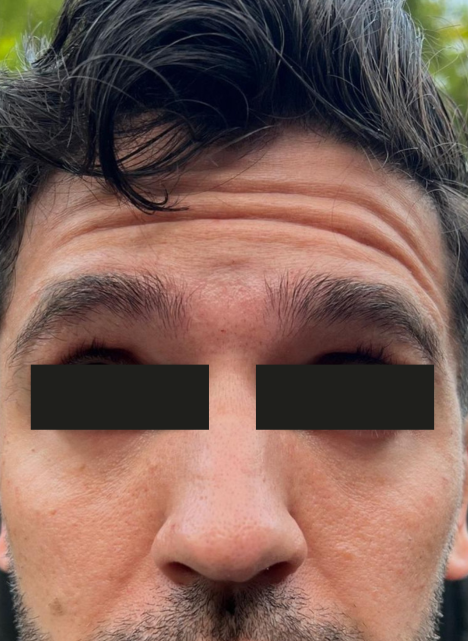 anti wrinkle injections 1 before