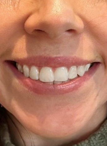 anti wrinkle injections 2 after