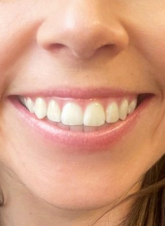 anti wrinkle injections 2 before