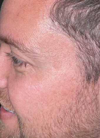 anti wrinkle injections 3 after