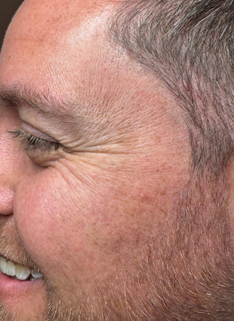 anti wrinkle injections 3 before