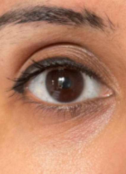 bright eyes 1 after