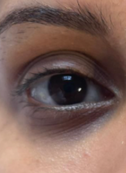bright eyes 1 before