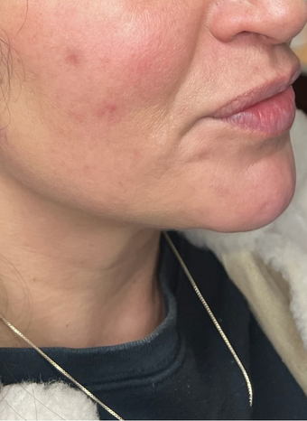 endolift 1 after