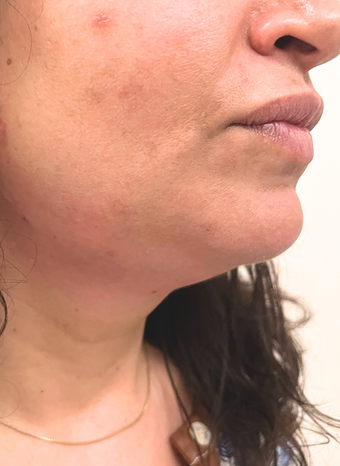 endolift 1 before