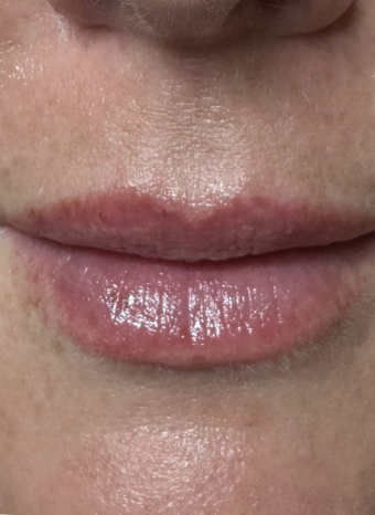 lip enhancement 1 after