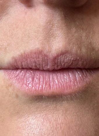 lip enhancement 1 before