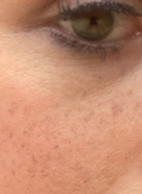 lumecca ipl therapy 1 after
