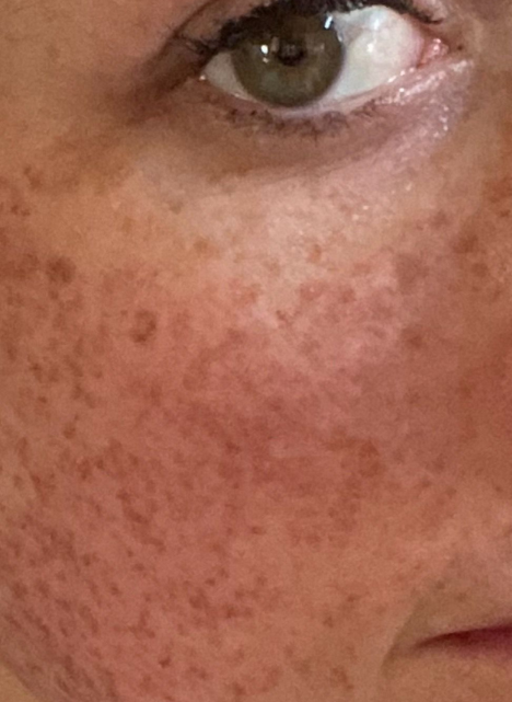 lumecca ipl therapy 1 before