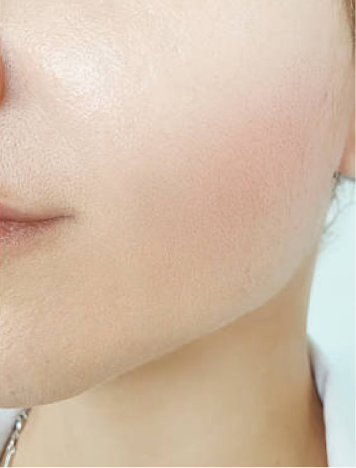 mesotherapy 1 after